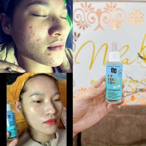 Serum giảm mụn, phục hồi da AA COSMETICS My Beauty Power Acne Niacinamide 10% - Thumbnail 4